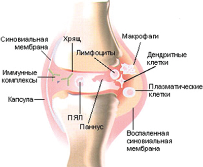 Ревматоидный артрит - загадочное заболевание суставов
